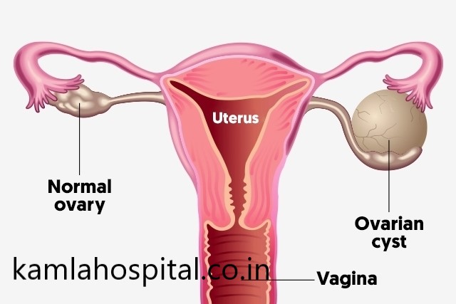 ovarian-cyst