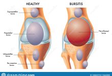 Suprapatellar-Bursa-Causes-Treatments