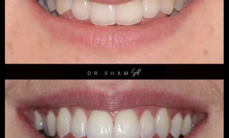 teeth whitening Surrey