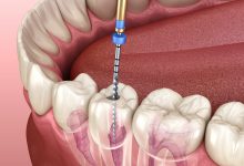 Can a Root Canal Fail?