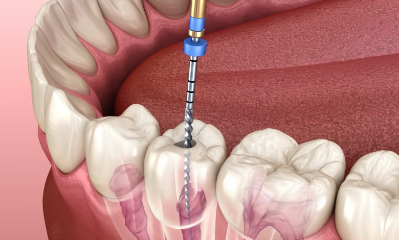 Can a Root Canal Fail?